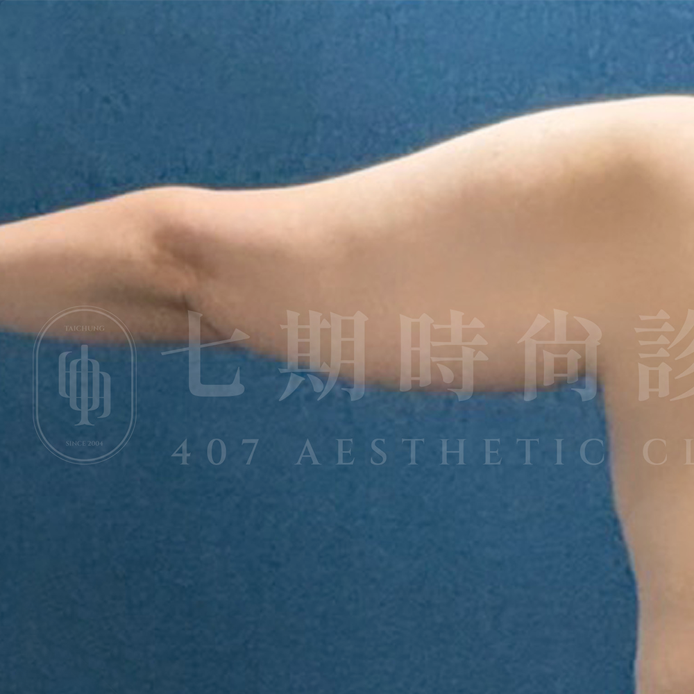 手臂抽脂02 B
