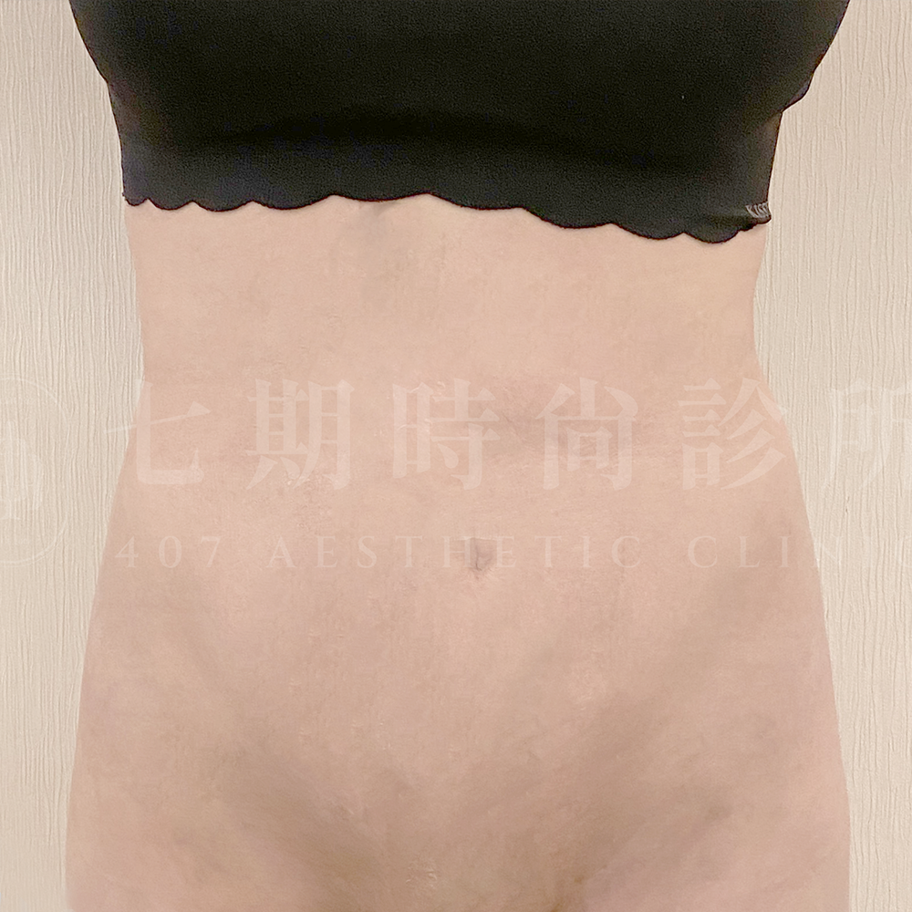 腹部抽脂01 A