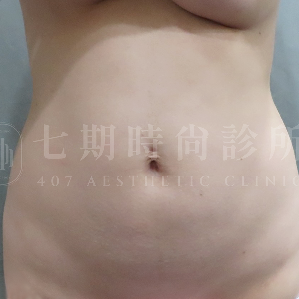腹部抽脂01 B